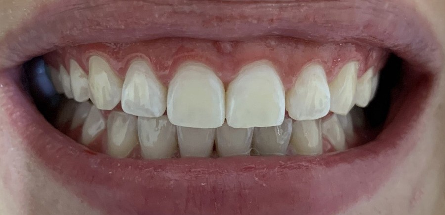 قبل تبيض-ليزر 2